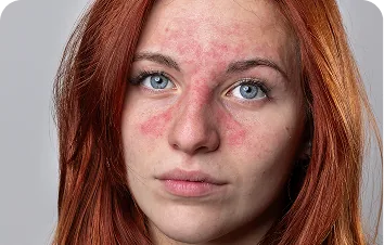Phymatous rosacea – woman with redness on the cheeks and nose
