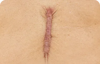 Hypertrophic and keloid scars – raised scar on the skin