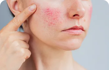 Hormonal acne – woman pointing to redness on her cheek