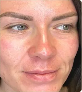 Hydrafacial Syndeo – face, after treatment (photo 1)