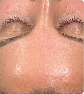 Hydrafacial Syndeo – forehead and eye area, after treatment (photo 2)