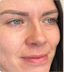 Hydrafacial Syndeo – face, before treatment (photo 1)