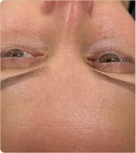 Hydrafacial Syndeo – forehead and eye area, before treatment (photo 2)