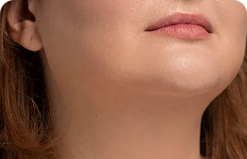Lipolytics for the face and double chin – a woman's chin and neck