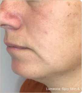Lumecca by InMode (IPL) – cheek in profile, after treatment (photo 1)