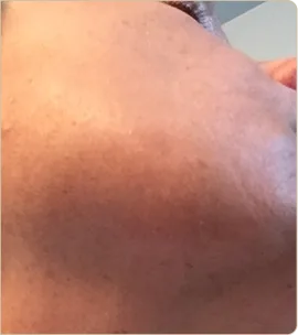 Lumecca by InMode (IPL) – cheek with pigmentation, after treatment (photo 2)