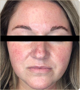 Lumecca by InMode (IPL) – face with redness, after treatment (photo 3)
