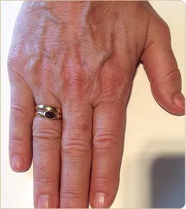 Lumecca by InMode (IPL) – back of the hand, after treatment (photo 4)