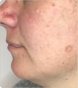 Lumecca by InMode (IPL) – cheek in profile, before treatment (photo 1)