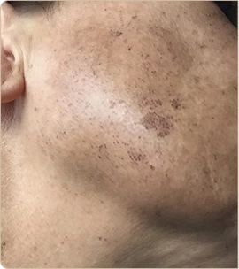 Lumecca by InMode (IPL) – cheek with pigmentation, before treatment (photo 2)