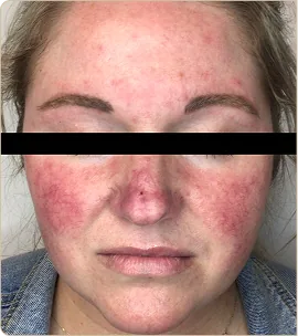 Lumecca by InMode (IPL) – face with redness, before treatment (photo 3)