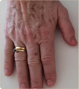 Lumecca by InMode (IPL) – back of the hand, before treatment (photo 4)