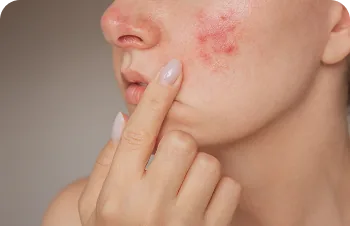 Teenage acne – young woman touching a red spot on her cheek