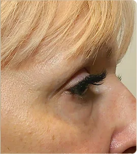 Morpheus8 Burst by InMode – eye area in profile, after treatment (photo 1)