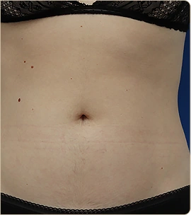 Morpheus8 Burst Body – abdomen, after treatment (photo 2)