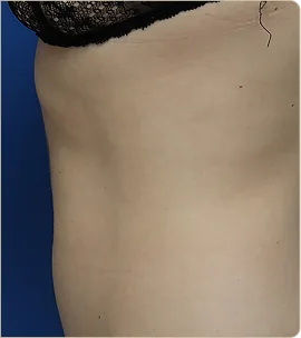 Morpheus8 Burst Body – abdomen and waist in profile, after treatment (photo 3)