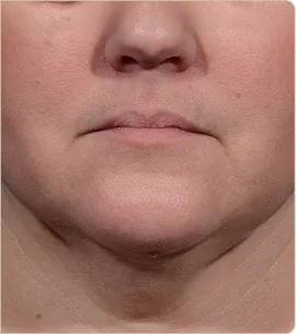 Morpheus8 Burst by InMode – lower face and chin, after treatment (photo 3)