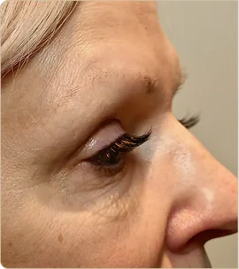 Morpheus8 Burst by InMode – eye area in profile, before treatment (photo 1)