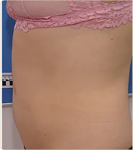 Morpheus8 Burst Body – abdomen and waist in profile, before treatment (photo 3)