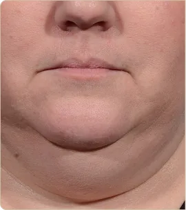 Morpheus8 Burst by InMode – lower face and chin, before treatment (photo 3)