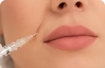 Nasolabial folds and marionette lines – injection beside the mouth