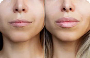 Volume and shape – two photos of lips side by side