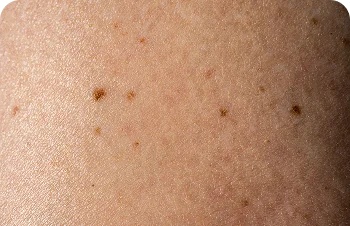 Common melanocytic moles – skin with small brown moles