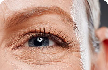 Crow's feet – close-up of lines around the eye