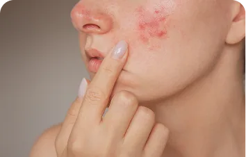 Papulopustular rosacea – woman touching red bumps on her cheek