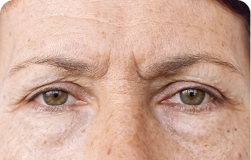 Sun spots – mature woman's face with freckles around the eyes