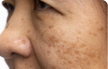Facial pigmentation – close-up of a cheek with pigmentation