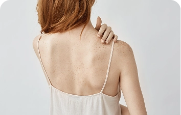 Pigmentation on the arms and body – woman with freckles on her shoulders and back
