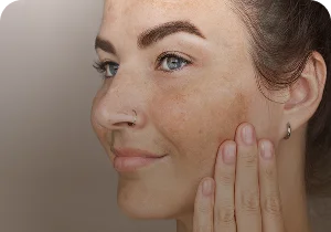 Woman with pigmentation on the cheek – pigmentation and melasma