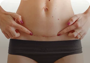 Abdomen with a surgical scar above the underwear – scar treatment