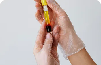 PRP for hair – gloved hand holding a tube of plasma