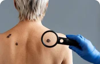 Suspicious or malignant skin lesions – mole on the back examined with a magnifier