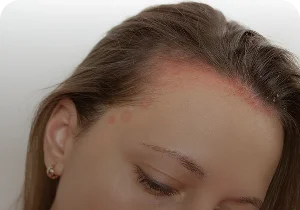 Redness along the hairline – seborrheic dermatitis and oily skin