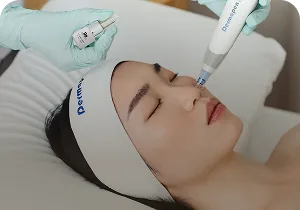 Facial microneedling with a Dermapen device – medical microneedling