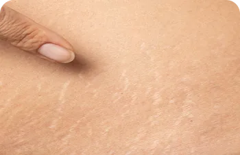 Stretch marks – close-up of skin with stretch marks
