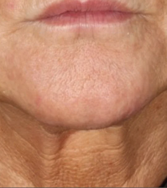 XERF by Cynosure Lutronic – neck and lower face, front view, after 2 treatments