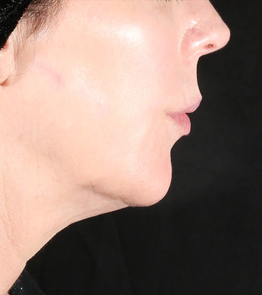 XERF by Cynosure Lutronic – profile, jawline and neck, after 2 treatments