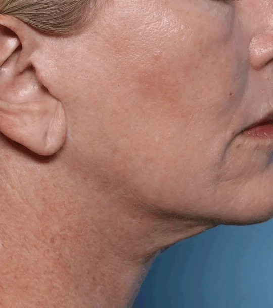XERF by Cynosure Lutronic – profile, contour and neck, 4 weeks after treatment