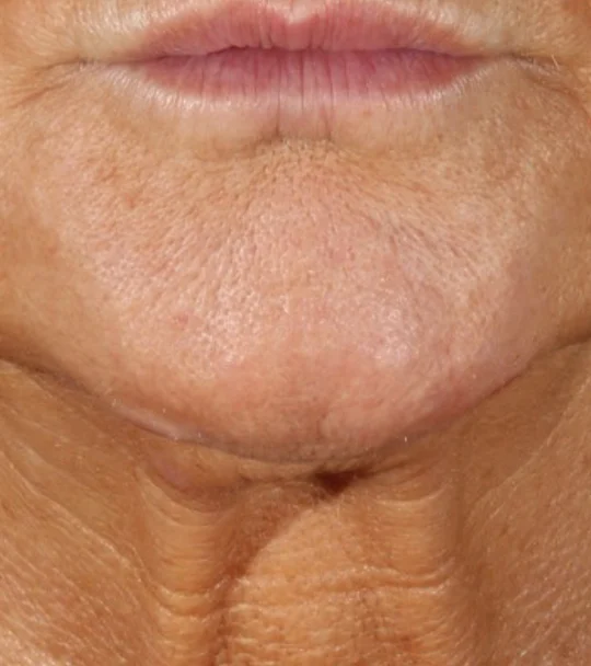 XERF by Cynosure Lutronic – neck and lower face, front view, before treatment