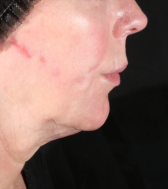 XERF by Cynosure Lutronic – profile, jawline and neck, before treatment