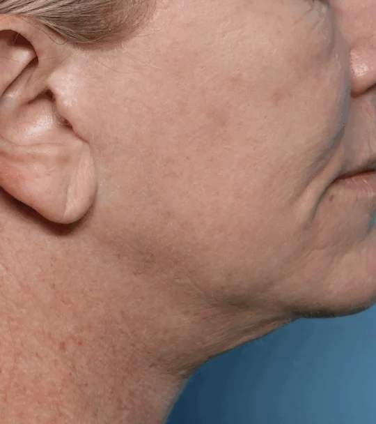 XERF by Cynosure Lutronic – profile, contour and neck, before treatment
